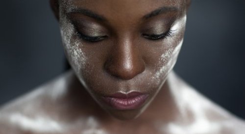 En Afrique de l'Ouest, de redoutables piqûres pour se blanchir la peau