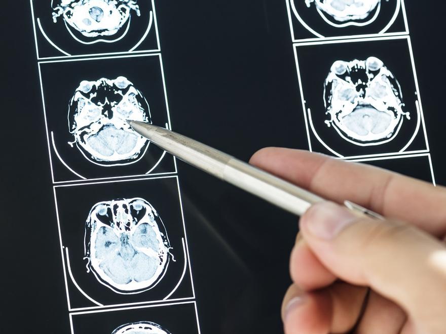 Qué es el daño cerebral adquirido y cómo podemos hacerle frente
