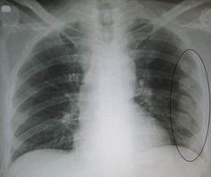 an x - ray image shows the chest and ribs