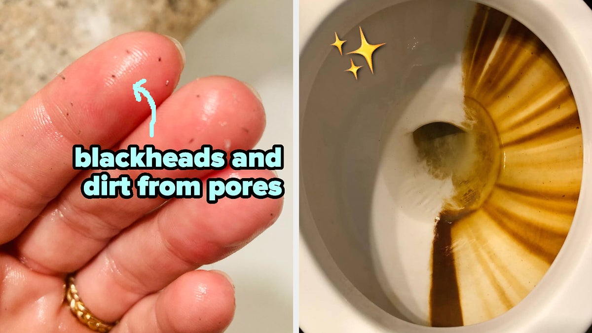 Left: Close-up of a hand showing extracted blackheads. Right: Inside of a toilet bowl with stains and half of it cleaned