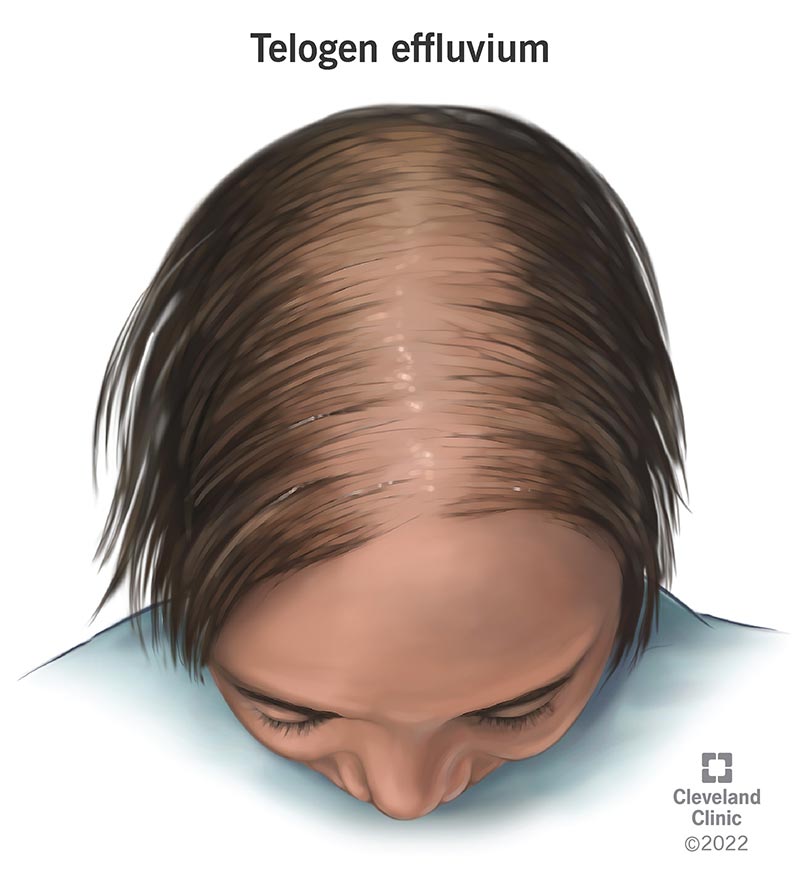 Thinning hair on the top of the head caused by telogen effluvium.