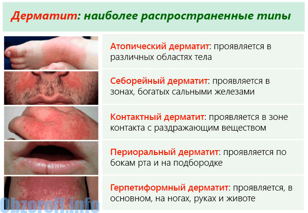 tipologija kozhnogo dermatita - Разновидности дерматита и рекомендации по его лечению
