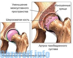 artroz sustava taza - Артроз тазобедренного сустава и методы лечения