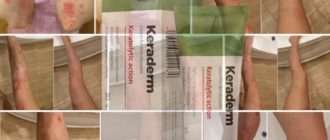 keraderm krem dlya lecheniya psoriaza - Keraderm для лечения псориаза: описание крема, инструкция
