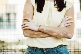 A woman with vitiligo stands with her arms crossed. White patches can be seen on her forearms.