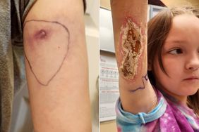 9-Year-Old Thinks Shirt Tag Pinched Her Until Mom Discovers a Brown Recluse Bite