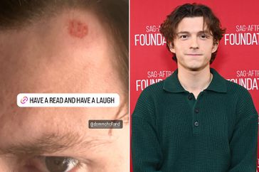 Tom Holland Shares Image of Painful Head Injury from Family Golf Day