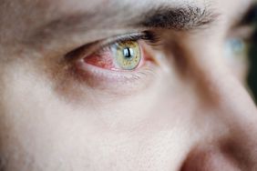 Closeup of irritated red bloodshot stressed eye at coronavirus covid-19