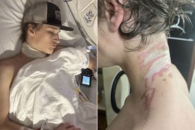 SCARS LEFT ON RAYCE OGDAHL, 16, AFTER HE WAS ELECTROCUTED BY HIS OWN CROSS NECKLACE IN BED