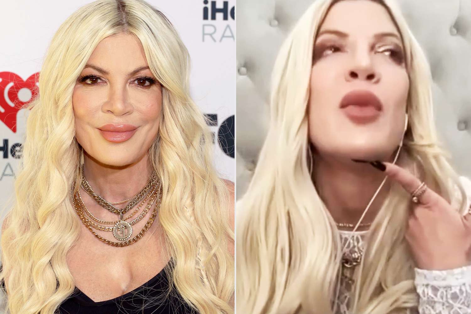 Tori Spelling Gets 6 Stitches on Her Chin after Fainting, Jokes She Should Have Asked Them to âMake It a Little Tighterâ