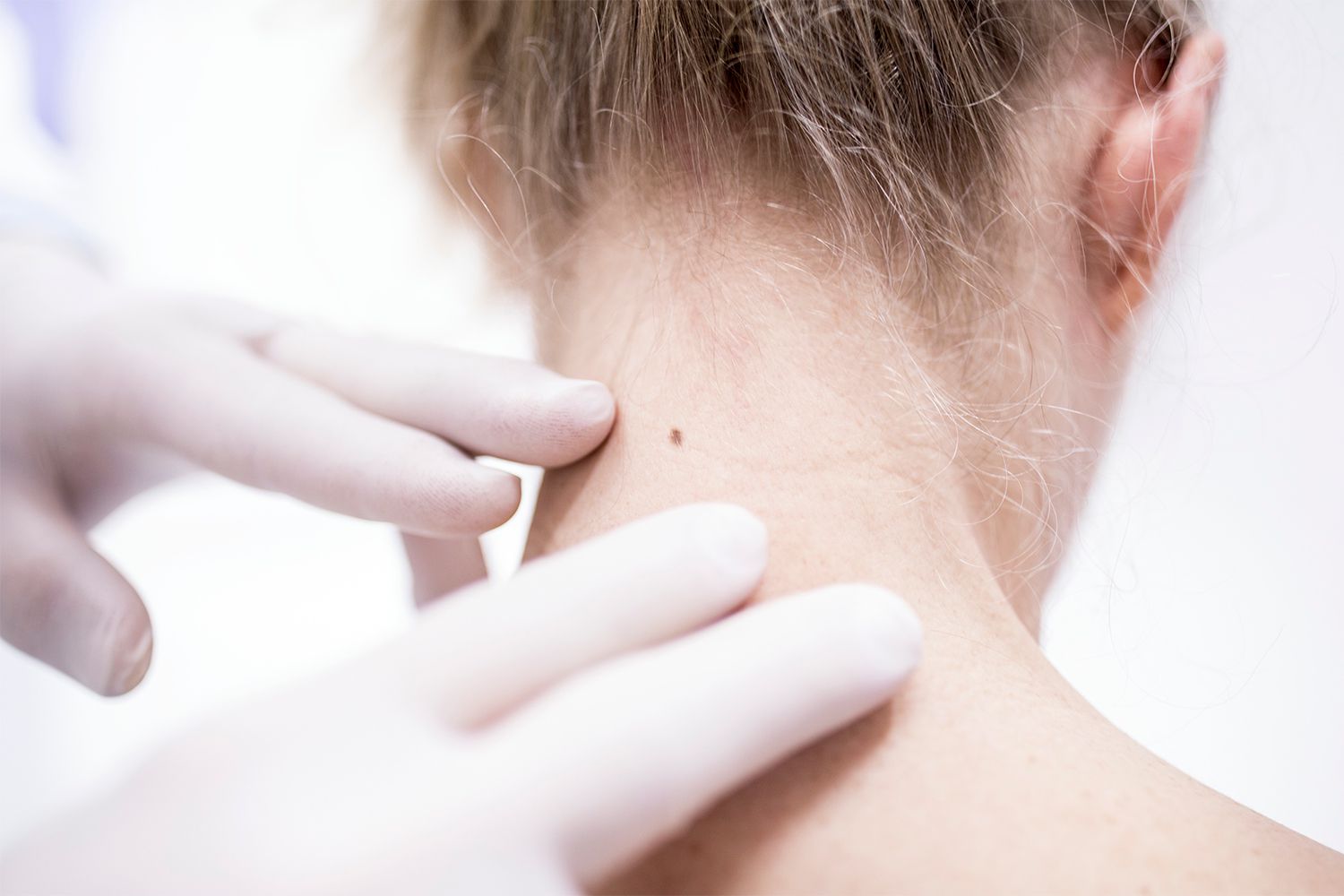 Doctor examining patient's mole on neck