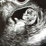 An ultrasound from a pregnancy during the 12th week.